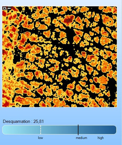 Corneofix® - scaliness/desquamation evaluation
