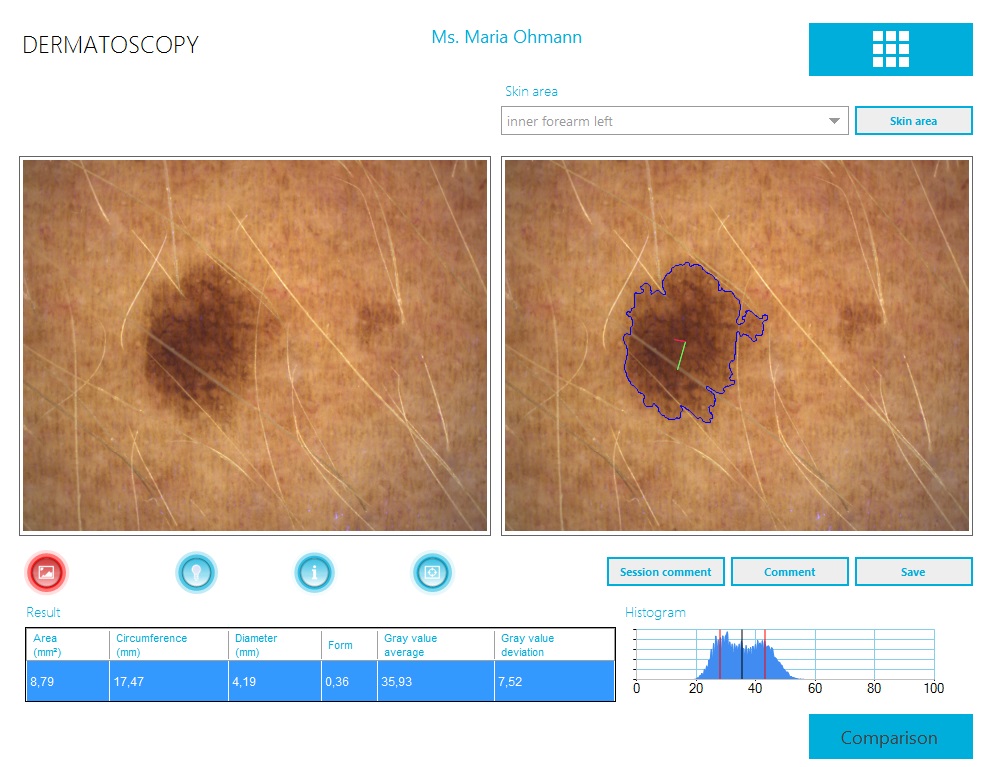 DC dermatoscopy e