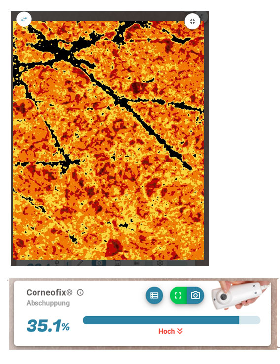 trockene Hautschüppchen mit Corneofix® und der Kamera untersuchen