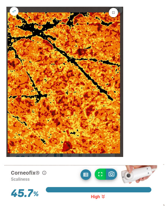 evaluate dry skin flakes with  Corneofix® and the camera