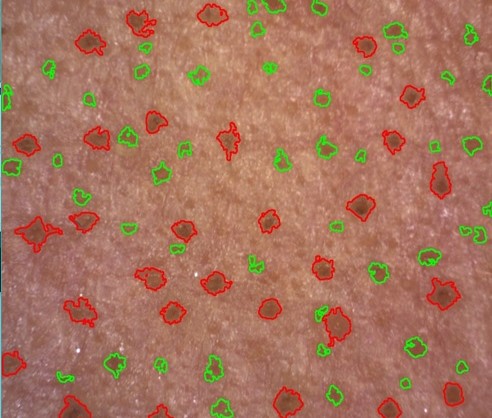 Betrachten Sie Poren mit kreuzpolarisiertem Licht