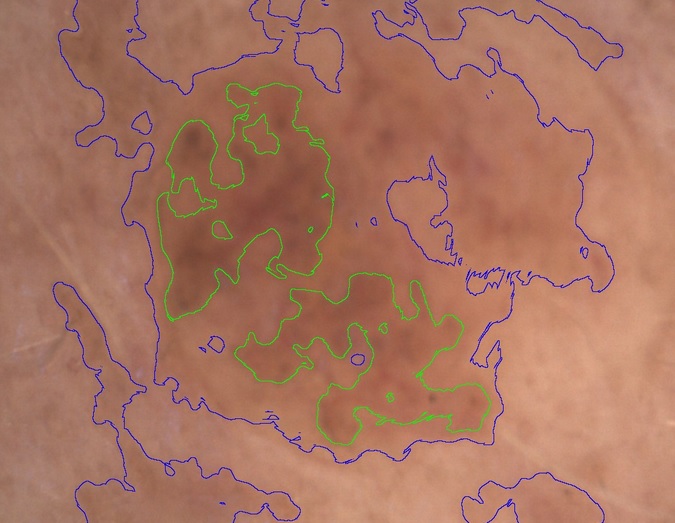 mit kreuzpolarisiertem Licht blicken Sie tiefer in die Haut und erkennen stärker pigmentierte Bereiche