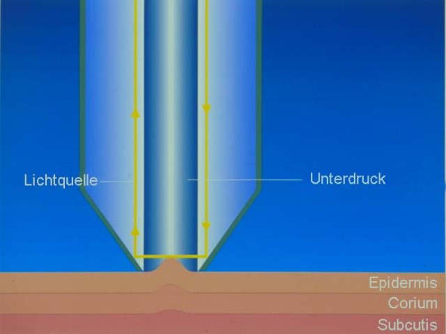 Cutometer principle d