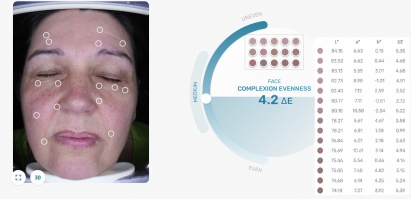 Eveness of complexion measured in the VisioFace® images